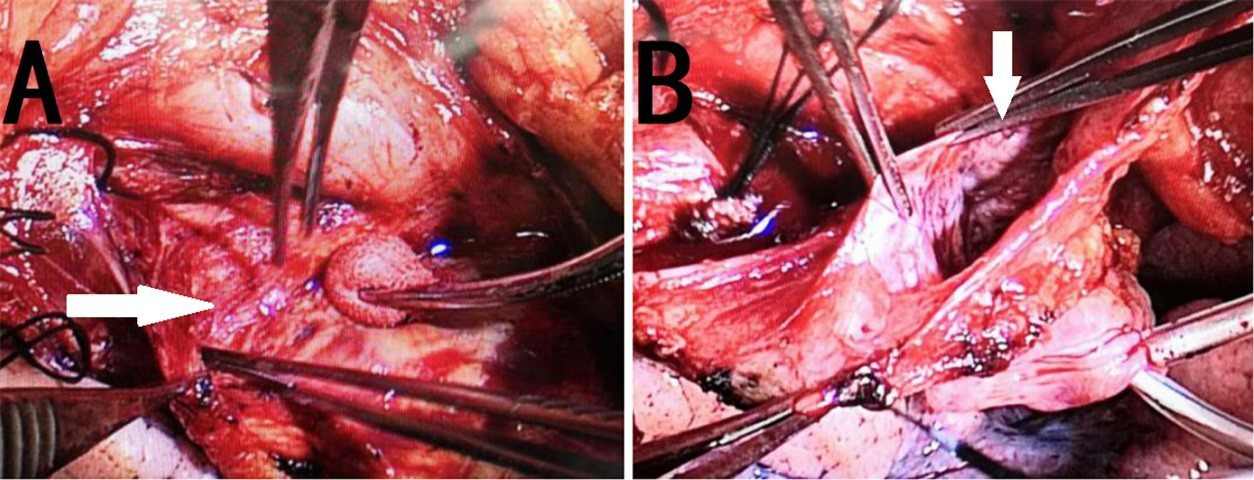 The surgical view of the superior vena cava aneurysm before (A) and after
(B) surgery.