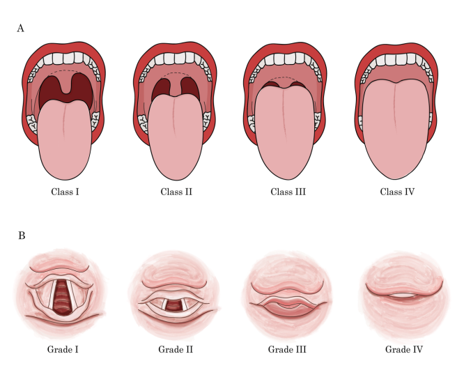(A). The Mallampati score. The Mallampati score is
based on the visualization of the pharyngeal structures and is used to predict
the degree of difficulty ofendotracheal intubation. Class I: visualization of
the soft palate, fauces, uvula, and both anterior and posterior pillars. Class
II: visualization of the soft palate, fauces, and uvula. Class III: visualization
of the soft palate and base of the uvula. Class IV: soft palate not visible.
(B). The Cormack & Lehane system classifies laryngeal views obtained by
directlaryngoscopy. Grade I: Full view of the glottis. Grade II: Partial view of
the glottis. Grade III: Only epiglottis and no glottis visible. Grade IV: Neither
glottis nor epiglottis visible.