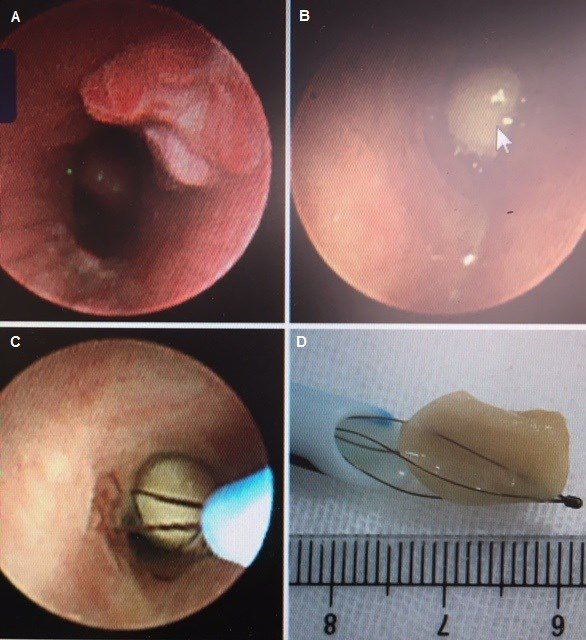A: endoscopic view of inflammatory response of the bronchial mucosa; B:
fruit seed occupying the bronchus; C: Zero Tip Nitinol Stone retrieval Basket; D:
The retrieval basket extracted contextually with the endotracheal tube.