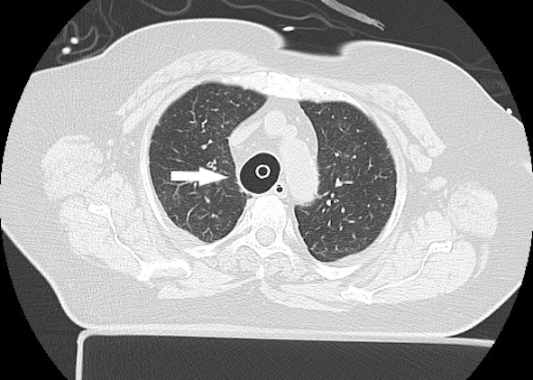 Computed tomography scan showing hyperinflated tracheal tube cuff in a patient with post-intubation tracheal injury (arrow).