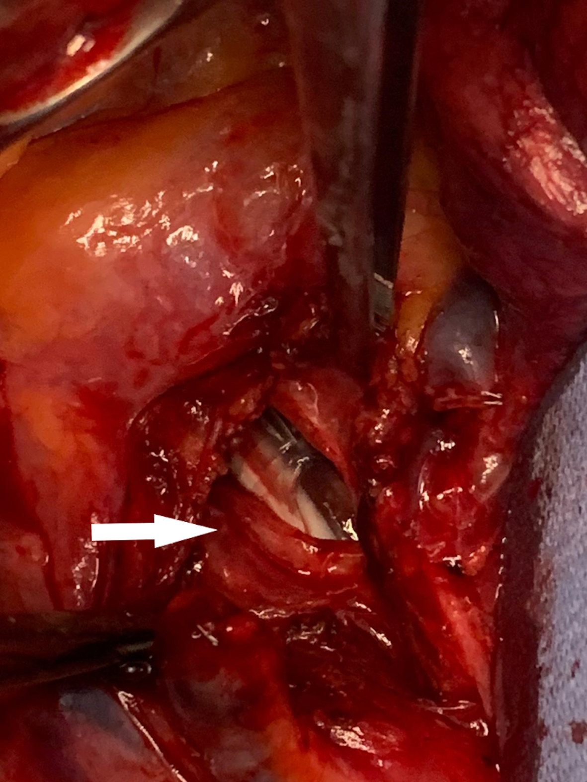 Operative view (right thoracotomy): intrathoracic post-intubation tracheal injury (arrow).