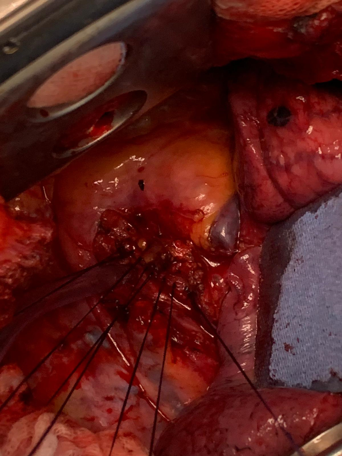 Surgical repair of the lesion with interrupted absorbable suture.