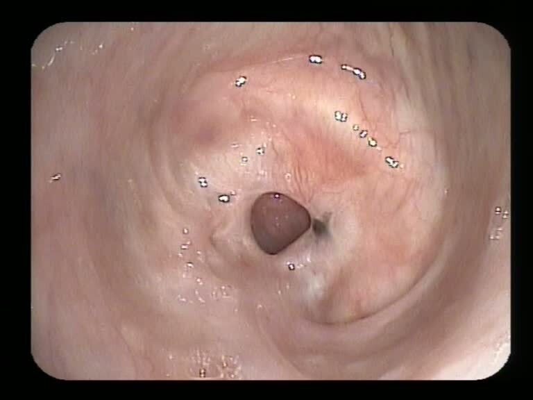 Shows a benign complex post-intubation stenosis.