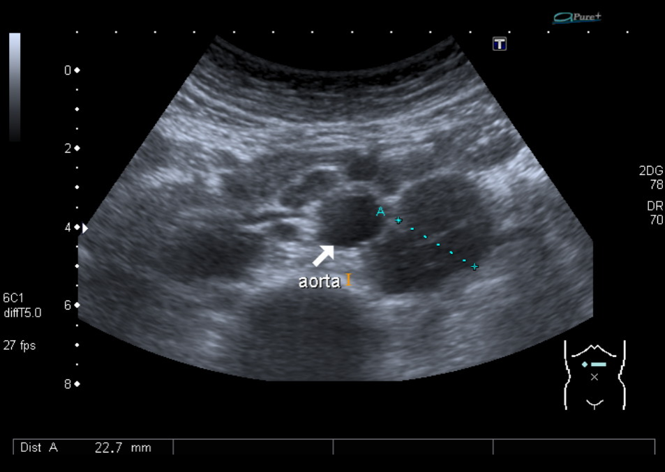 Sonography Image of enlarged Paraaortic Lymph Nodes.