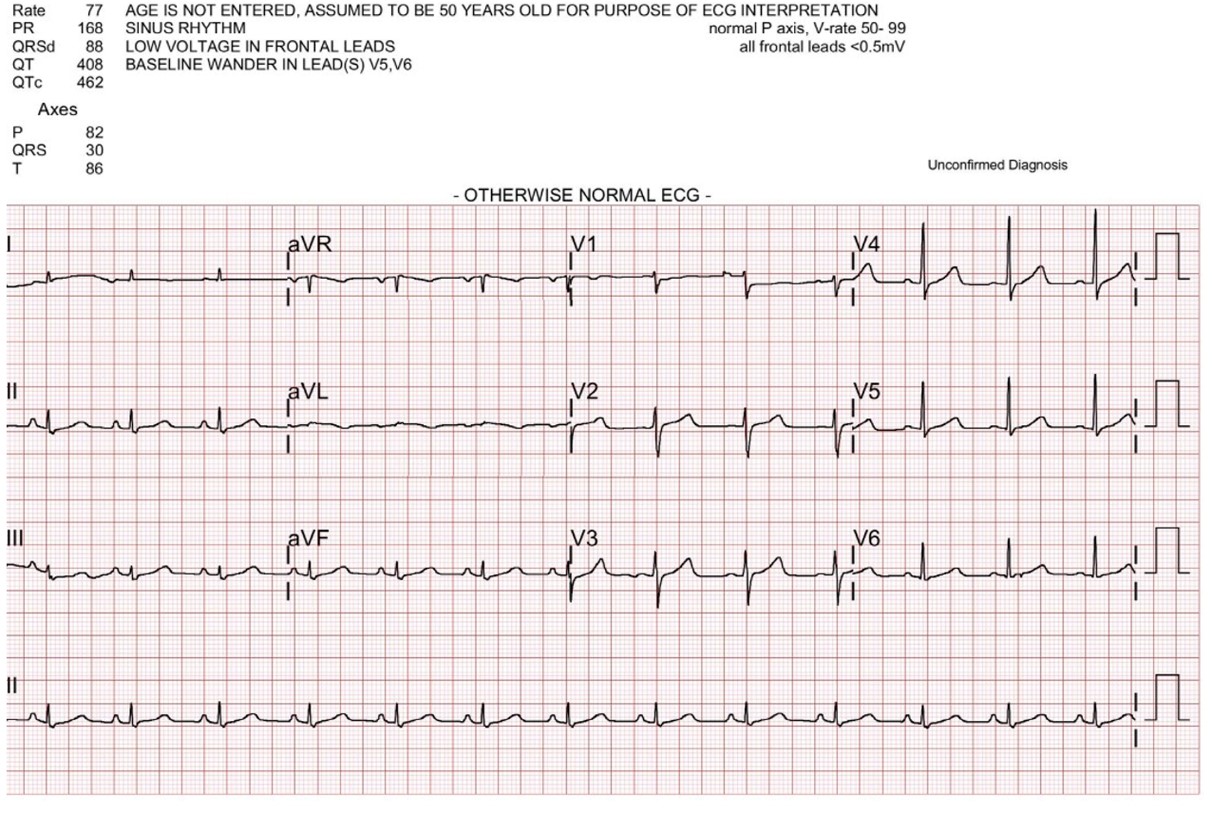 Initial electrocardiogram (ECG) in the emergency department (ED)
was normal sinus rhythm (3 hours after epinephrine injection).