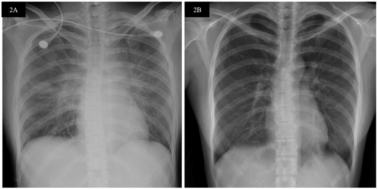 (A) Significant lung exudation and edema in chest X-ray (day
1), (B) Improving pulmonary edema (day 3).