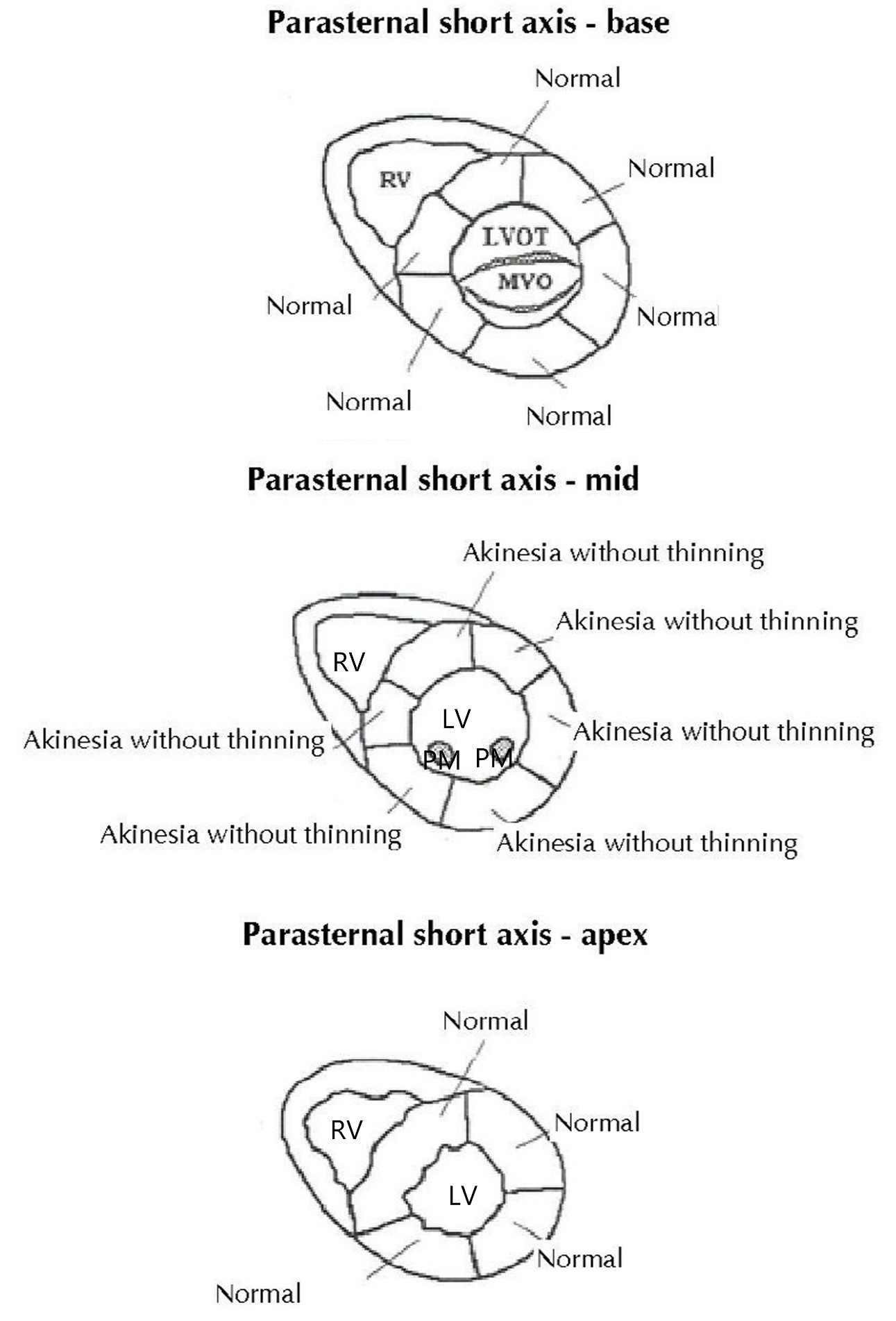 Analysis of regional wall motion seen on the patient’s initial
echocardiography. Left ventricle (LV), right ventricle (RV), left ventricular outflow
tract (LVOT), mitral valve opening (MVO) papillary muscle (PM).