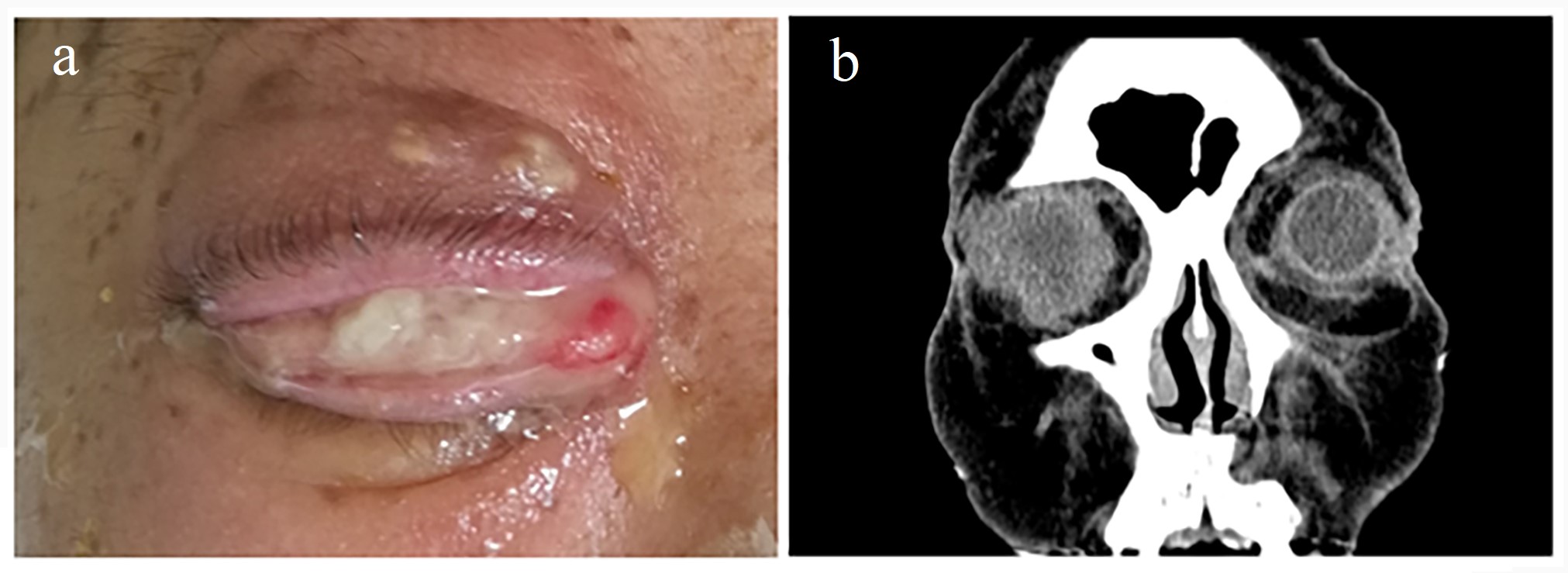 Visual appearance and computed tomography (CT) scan of
the patient’s right eye. (a). Right eye swelling with purulent discharge was
visible. (b). The vitreous density of the right eye was uneven, and exudation was
observed around the right eyeball.