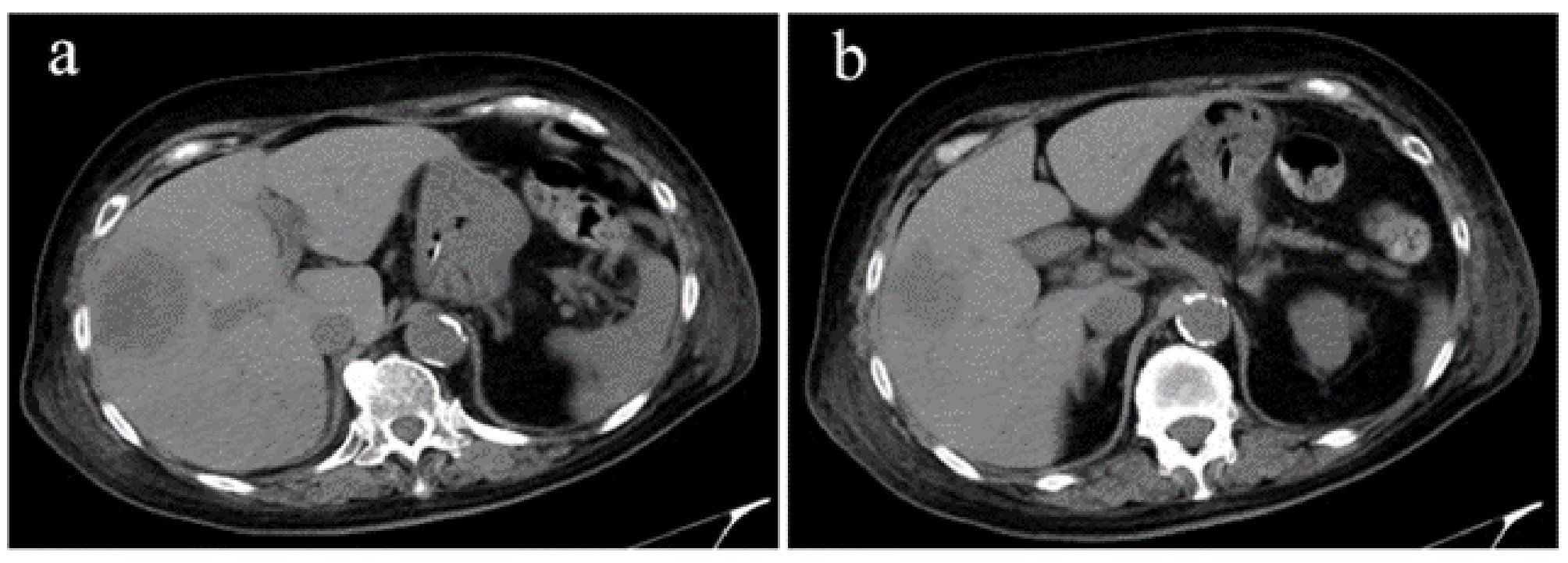 CT scans showing low-density areas in the right lobe of
the liver. (a). The maximal diameter of the low-density areas in the right lobe
was 4.65 cm. (b). A patchy low-density shadow was seen in the right lobe of the
liver.
