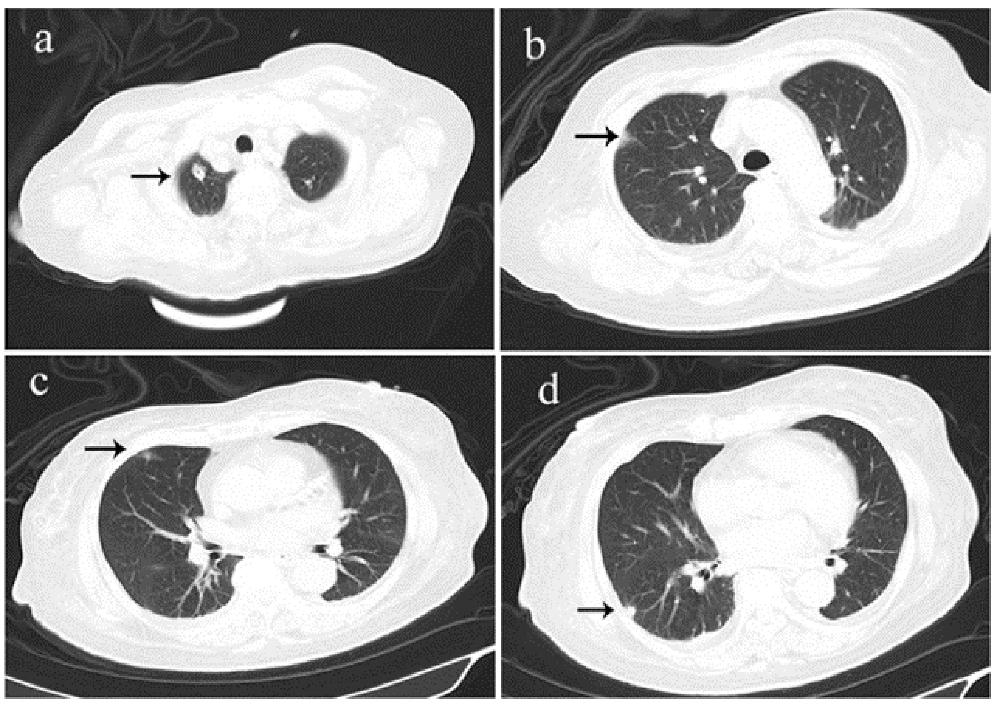 CT image of the patient’s lungs. (a). A small cavity
was observed in the upper right lobe. (b) and (c). Ground-glass opacities were
seen in the upper right lobe. (d). A solitary nodular shadow was visible in the
lower right lobe near the pleura.