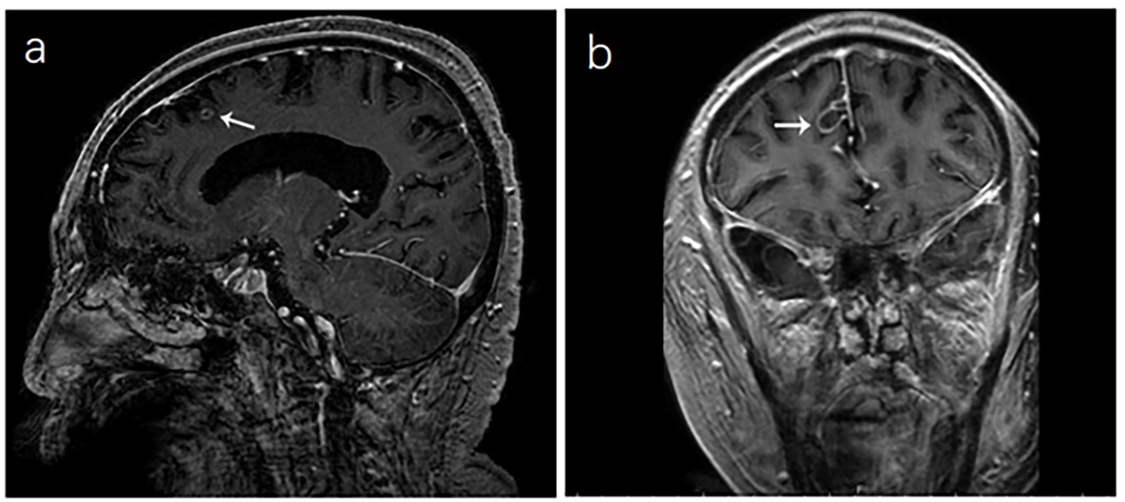 Contrast-enhanced magnetic resonance imaging of the
brain. (a). Imaging on the sagittal plane revealed a ring-enhancing lesion
(maximum diameter, 0.2 cm) located in the left forehead. (b). Imaging on the
coronal plane showed a ring-enhancing lesion (maximum diameter 0.5 cm) in the
left forehead.