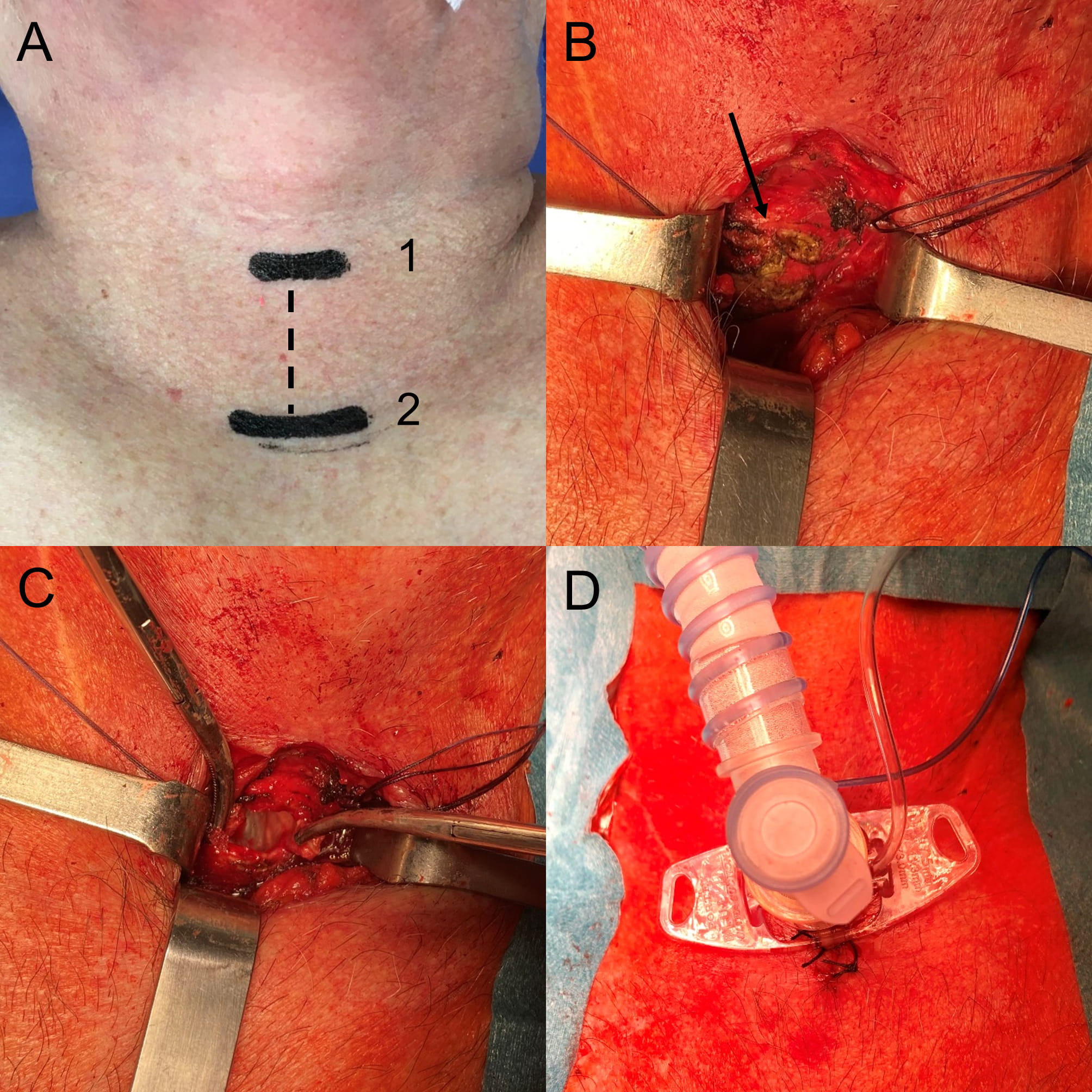 Technique of open surgical tracheotomy. Anatomical landmarks for skin incision to perform an
emergency open surgical tracheotomy. (A) A vertical incision (dotted
line) is created on the midline between the cricoid cartilage (1) and the sternal
jugular incisure (2). (B) After thyroid isthmus division, the anterior
tracheal wall is approached with an inverted ‘H’ shaped incision (arrow) leaving
intact the cricoid and the first tracheal rings. (C) The trachea is
opened and (D) A tracheal cannula is inserted through the stoma. The
wound is then closed around the cannula with interrupted silk stitches.