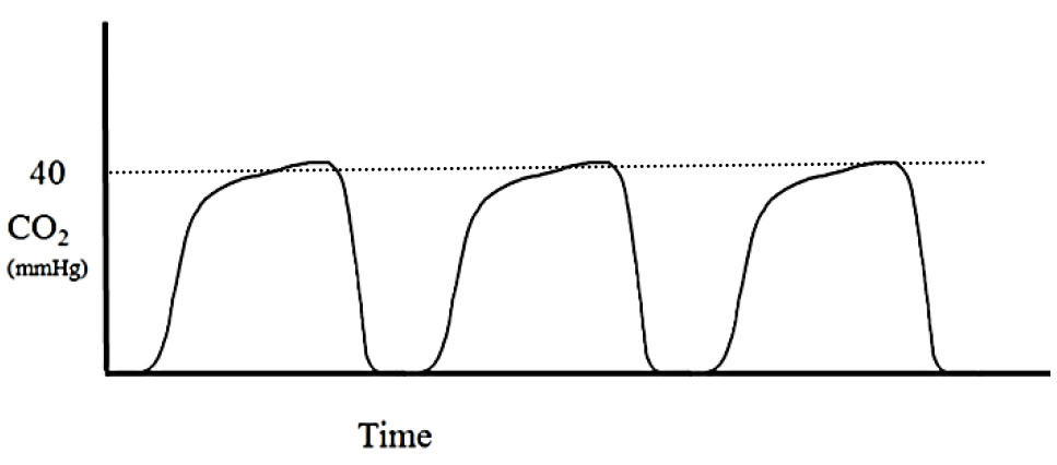Applications of capnography in airway management outside the operating room figure 3