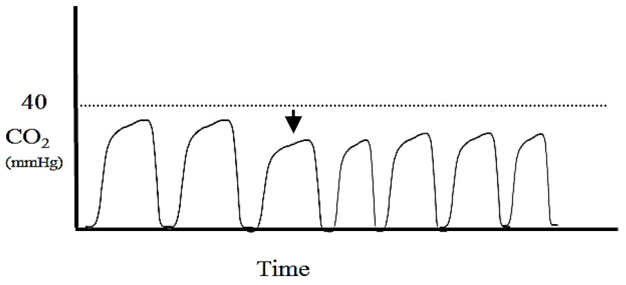 Applications of capnography in airway management outside the operating room figure 4
