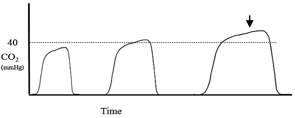 Applications of capnography in airway management outside the operating room figure 5