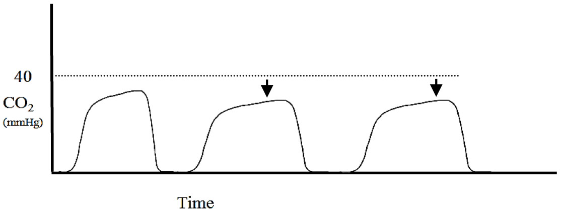 Applications of capnography in airway management outside the operating room figure 6