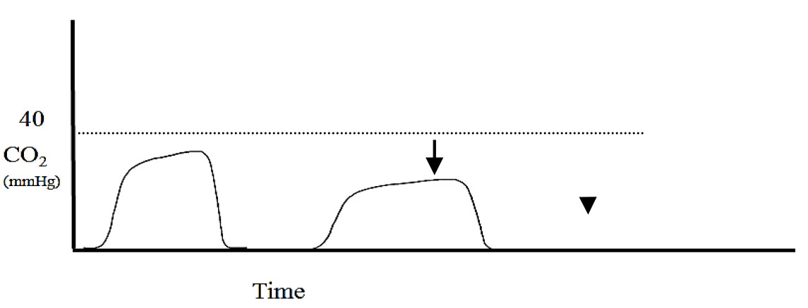 Applications of capnography in airway management outside the operating room figure 7