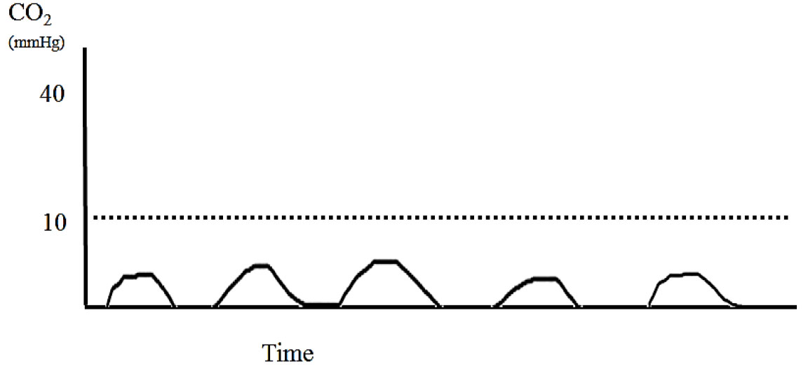 Applications of capnography in airway management outside the operating room figure 8