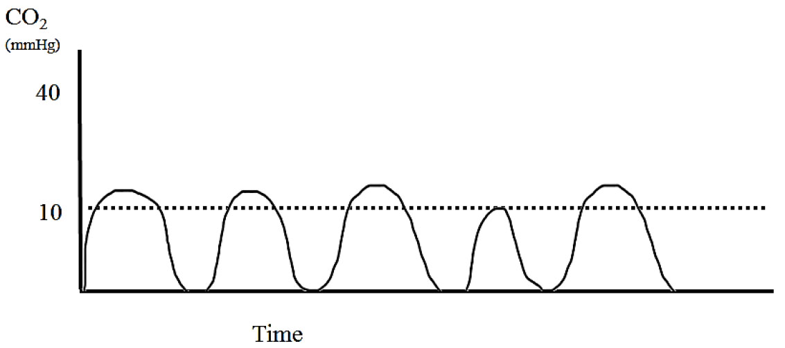 Applications of capnography in airway management outside the operating room figure 9