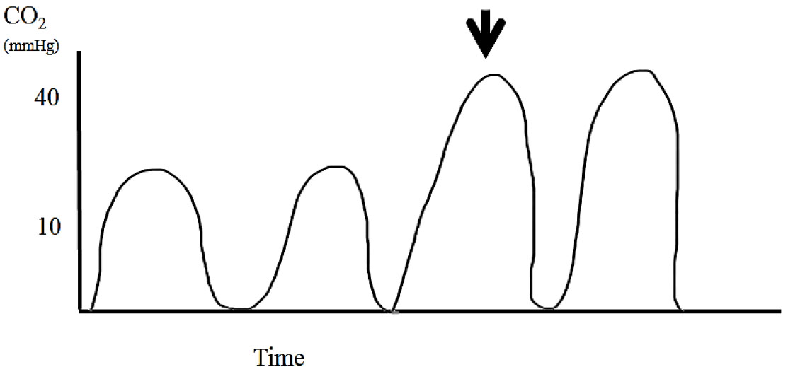 Applications of capnography in airway management outside the operating room figure 10