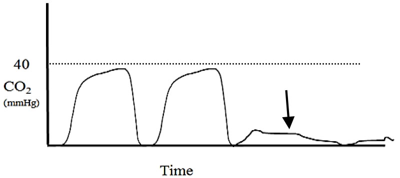 Applications of capnography in airway management outside the operating room figure 11