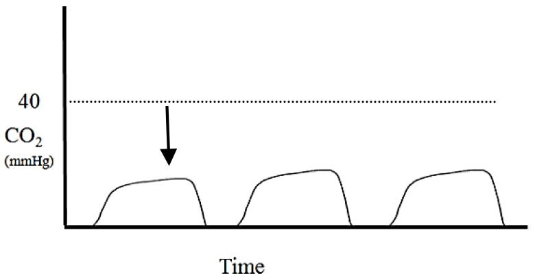 Applications of capnography in airway management outside the operating room figure 12