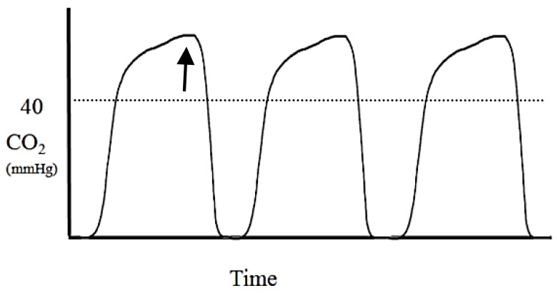 Applications of capnography in airway management outside the operating room figure 13