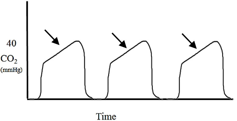 Applications of capnography in airway management outside the operating room figure 14