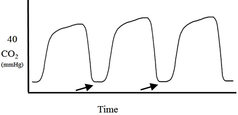 Applications of capnography in airway management outside the operating room figure 15