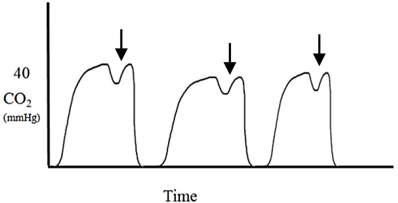 Applications of capnography in airway management outside the operating room figure 16