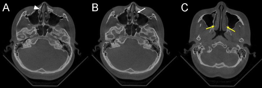 The patient’s preoperative dental cone beam computed tomography
axial image. (A) Nasal septal deviation to the right (white arrowhead). (B)
Concha bullosa of the left middle turbinate (white arrow). (C) Inferior turbinate
hypertrophy (yellow arrows).