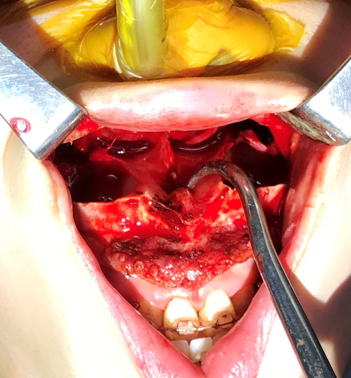 Intraoperative clinical photograph of nasotracheal intubation
(NTI) after maxillary downfracture. NTI via a nasal Ring-Adair-Elwyn tube with
an internal diameter of 6 mm was successful after maxillary downfracture.