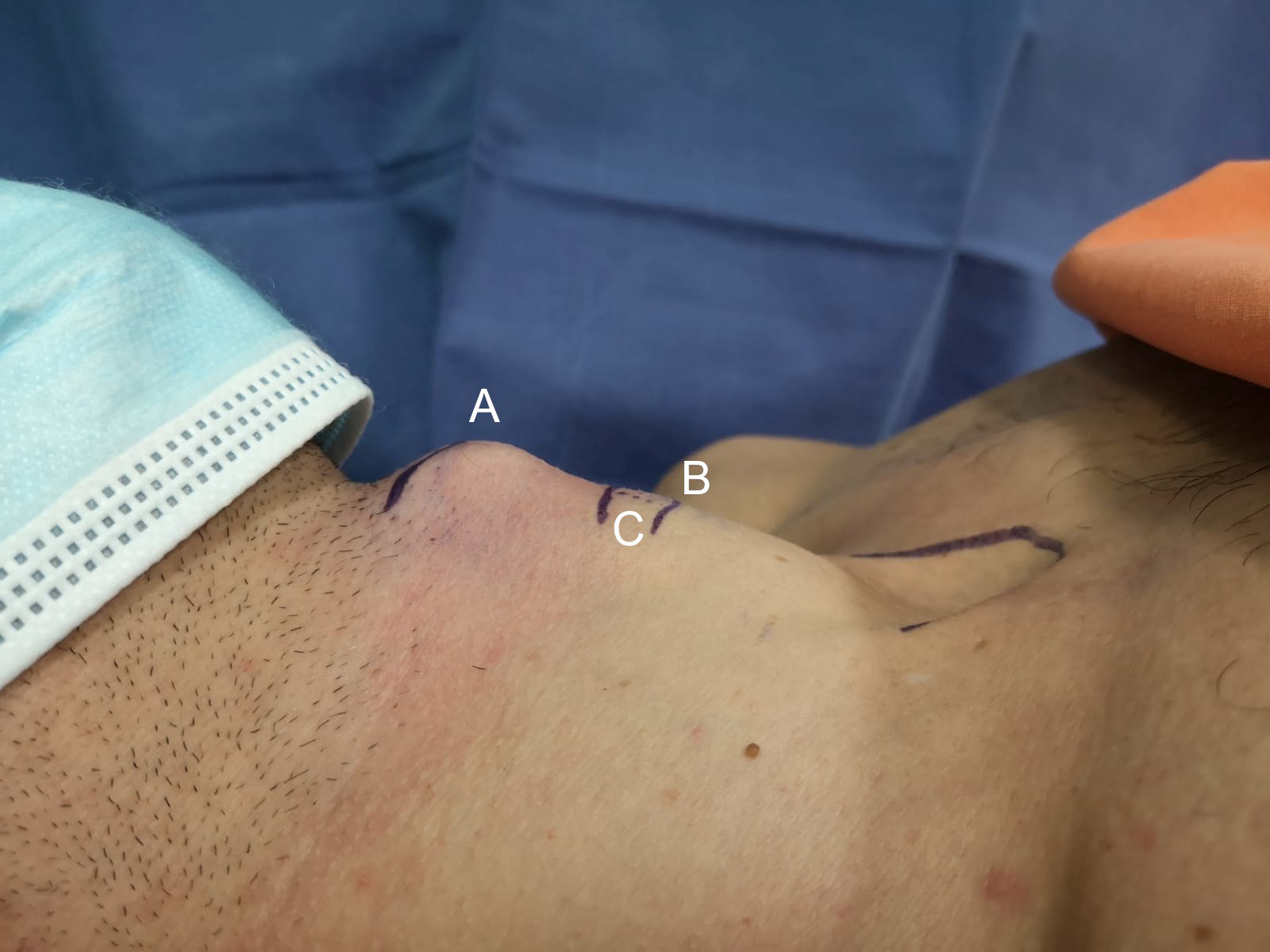 Neck, lateral view. (A), thyroid prominence; (B), cricoid
prominence; (C), cricothyroid membrane.
