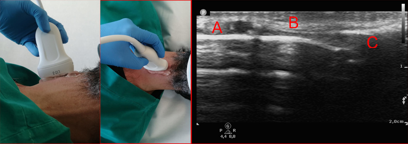 Ultrasound localization of the cricothyroid membrane. Left and
central images: lateral and anterior view of the ultrasound neck examination.
Right image: ultrasound view; (A) cricoid cartilage, (B) cricothyroid membrane,
(C) thyroid cartilage.