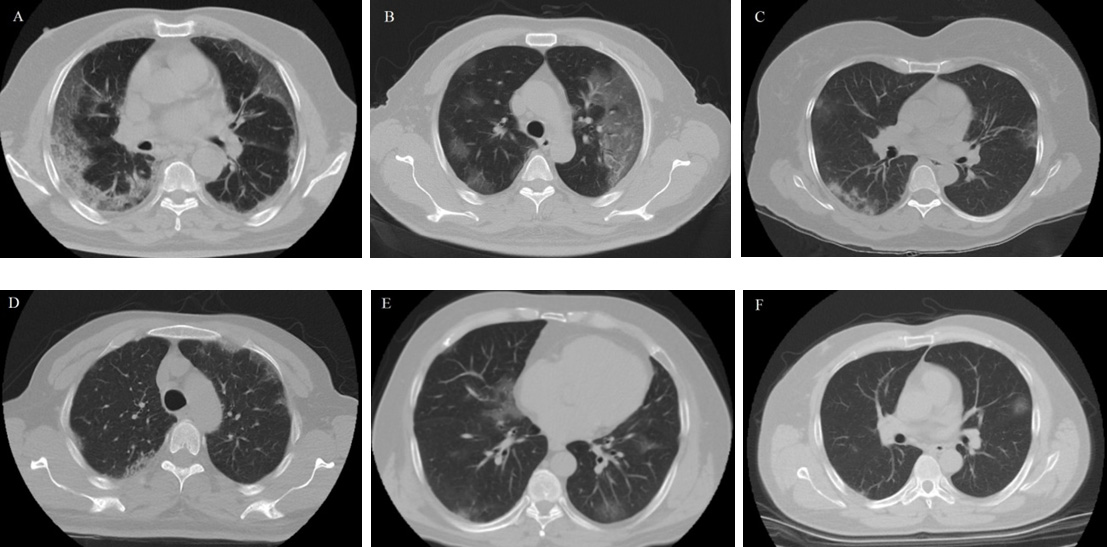 Chest CT images of six critically ill patients. (Case A,B) Chest
CT image sections from a 70 and 59-year-old men with confirmed COVID-19,
respectively. Their c-CT images showed bilateral multilobular ground-glass
density areas, subpleural interlobular septal thickening and consolidation areas
in the lower lobes. (Case C,D) Chest CT image sections from a 50-year-old woman
and 63-year-old man with negative RT-PCR test over the hospital stay,
respectively. PaO2/FiO2 ratios of both were very low (131 and 116).
(Case E,F) Chest CT image sections from a 56 and 52-year-old men with confirmed
COVID-19 on admission. Chest CT images showed bilateral subpleural and focal
ground-glass density areas in the lower lobes more specifically. Their RT-PCR
tests converted from negative to positive 3rd and 4th days after the first
admission, respectively.