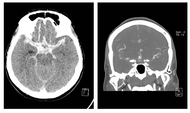 Head CT (left) and CTA (right) at time of admission to a
Division of Neurology (CT—Computed Tomography, CTA—CT Angiography).