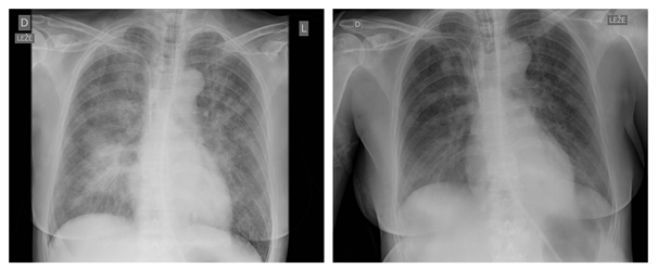 Chest X-ray at time of admission to a Division of Neurology
(left) and the next day (right).