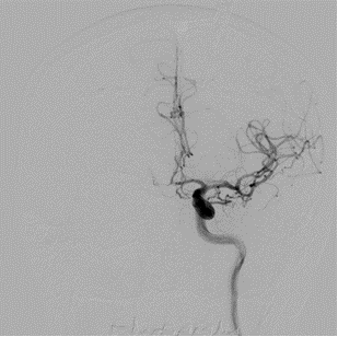 DSA after endovascular coiling of the aneurysm (DSA—Digital
Subtraction Angiography).