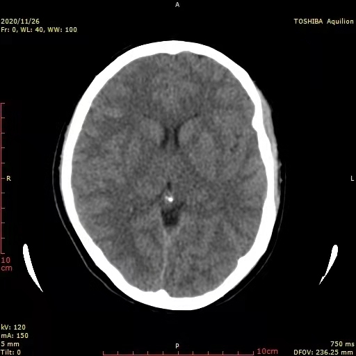 Cerebral CT showed diffuse edema in both hemispheres.