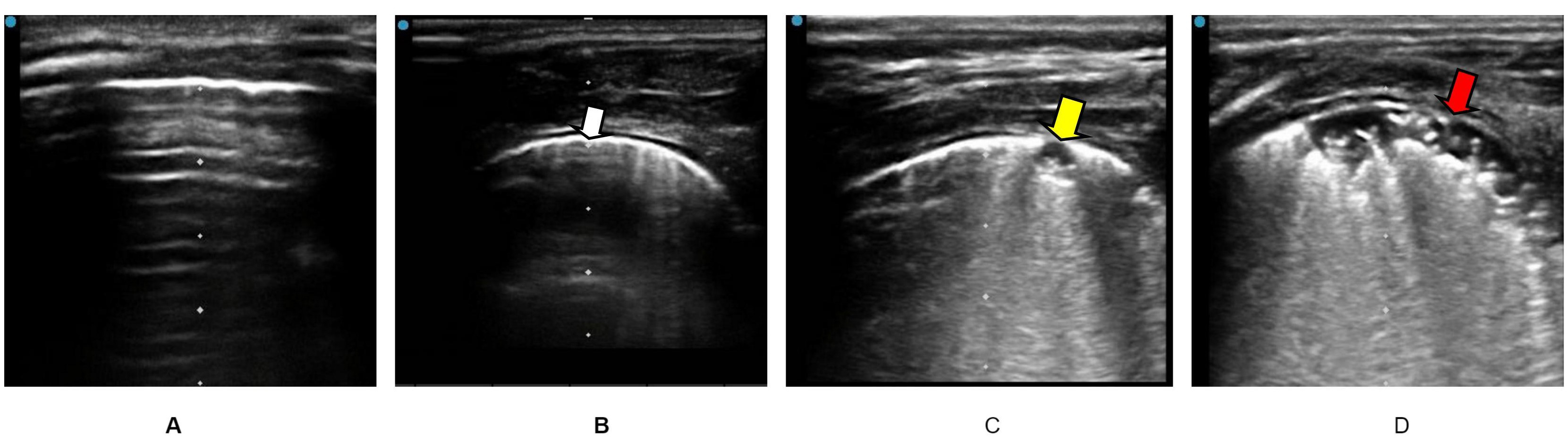 Reference diagram of lung consolidation score. (A) 0, no
consolidation; (B) 1, white arrows indicate minimal pleura consolidations; (C) 2,
yellow arrows indicate small-sized consolidations; (D) 3, red arrows indicate
large-sized consolidations.