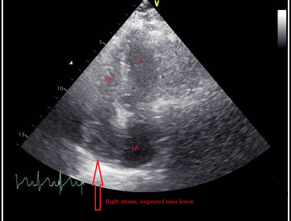Transthoracic echocardiography, four chamber view.