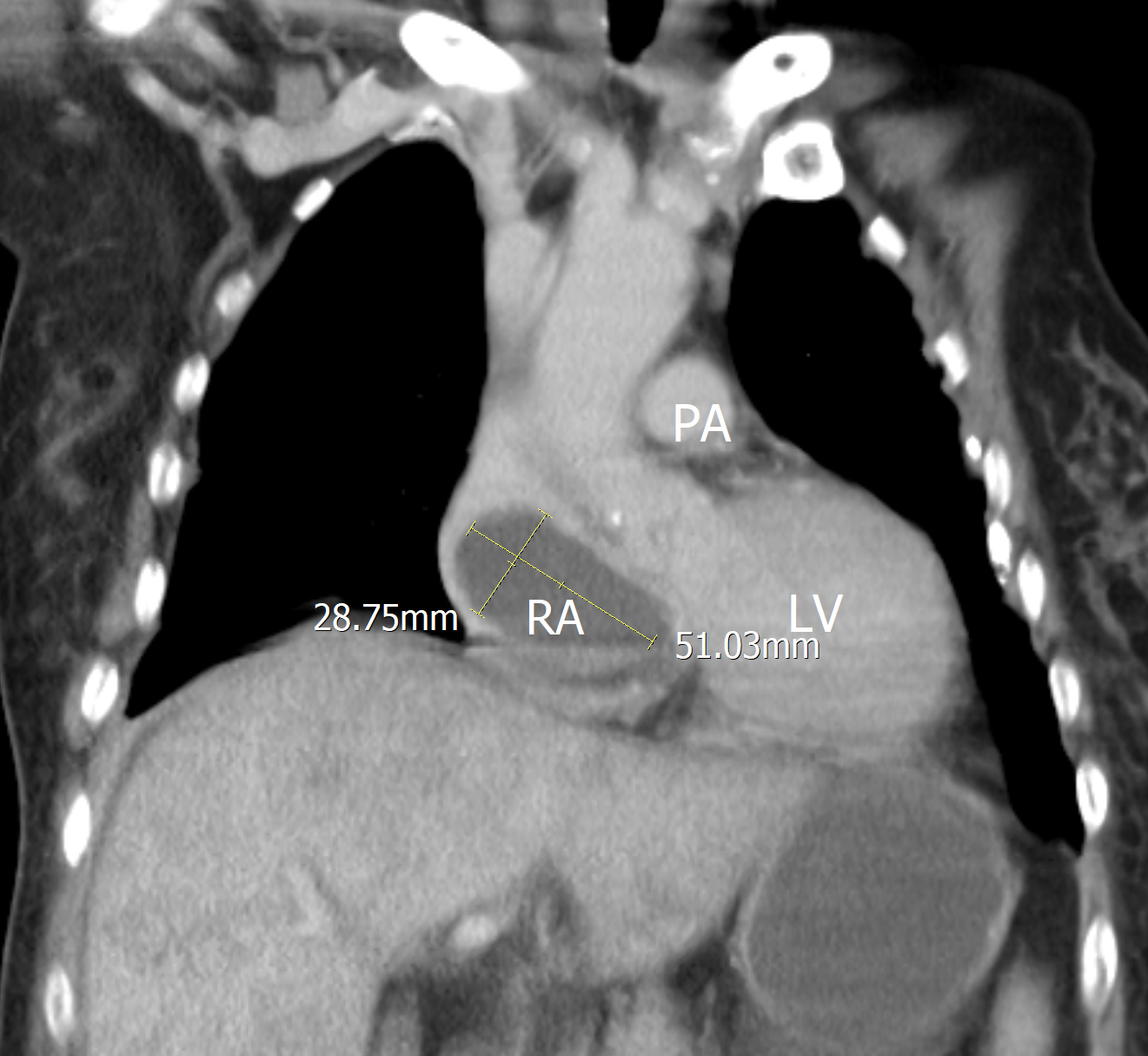 Coronal section revealed a lesion about 67 × 50
× 63 mm in the right atrium.
PA, pulmonary artery; RA, right atrium; LV, left ventricle.