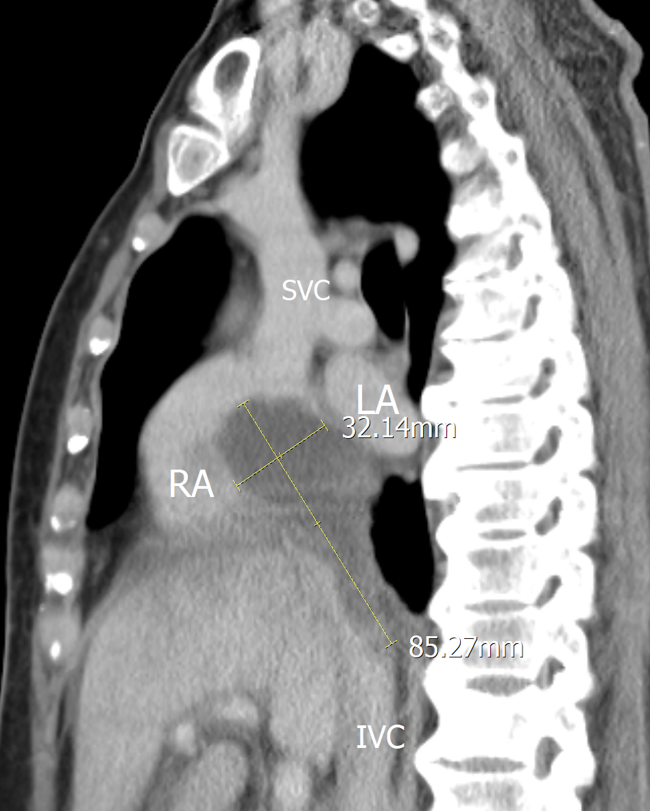 Sagittal section revealed a poorly enhanced lesion in the right
atrium with inferior vena cava extension.
LA/RA, left and right atrium; SVC/IVC, superior/inferior vena cava.