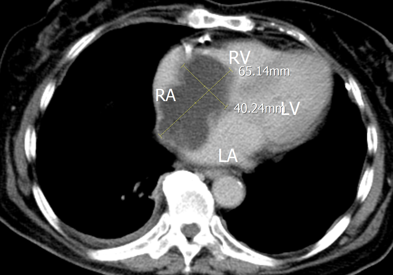 Axial section revealed a poorly enhanced lesion in the right
atrium with inferior vena cava extension.
