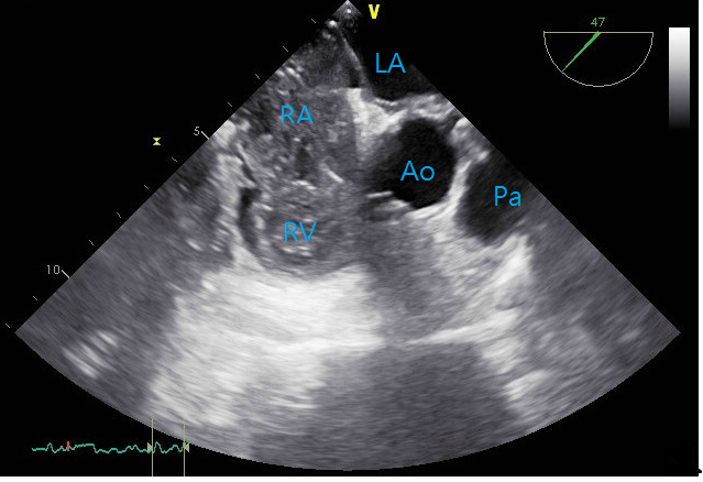 Transesophageal echocardiography, mid-esophageal.
Ao, aorta; Pa, pulmonary artery.