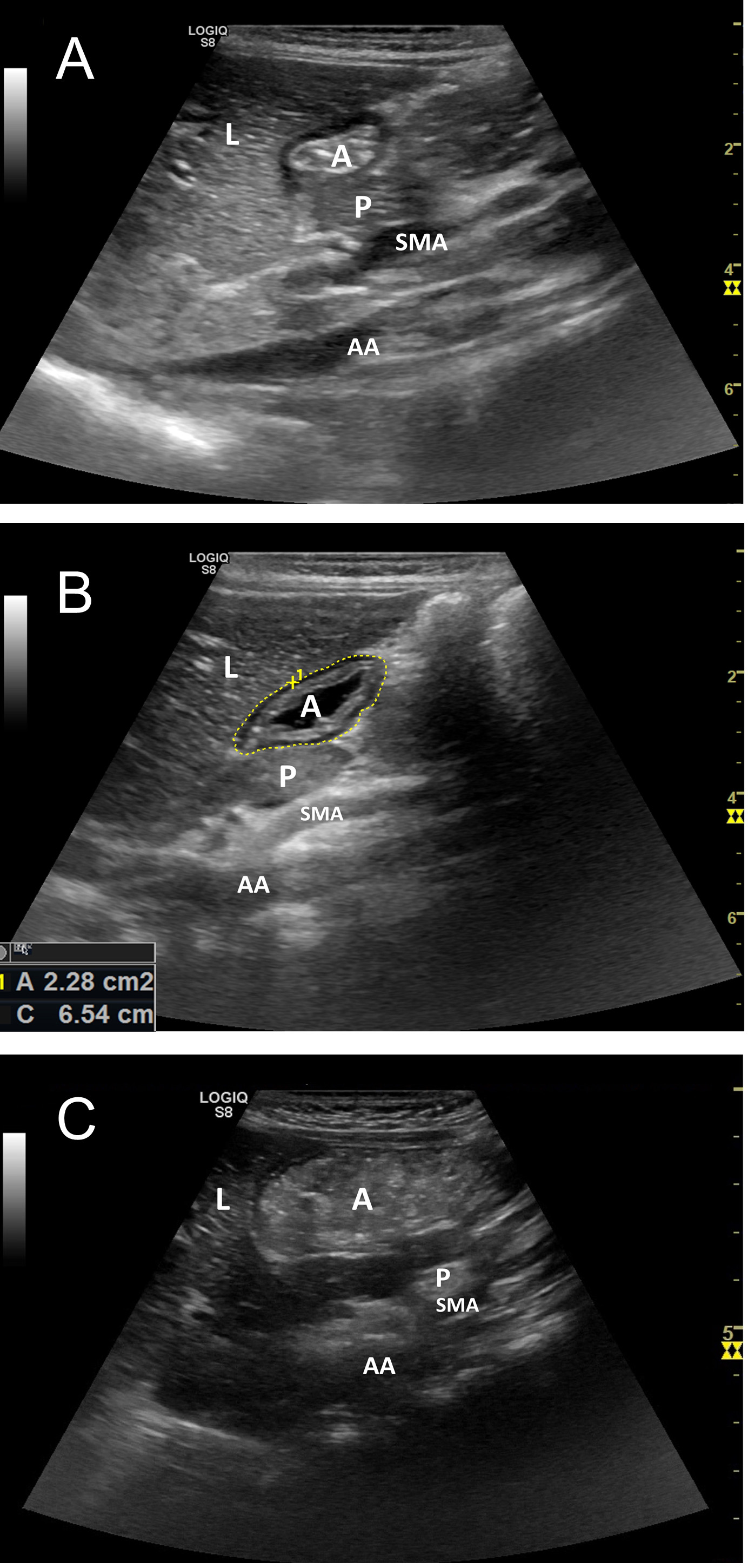 Interpretation of ultrasound images. Gastric contents were
assessed as empty (A), liquid (B), and solid (C). Cross-sectional area (CSA) of
the antrum can be evaluated by tracing the circumference of the antrum following
the serosal layer (yellow dotted line). The gastric volume can be estimated from
the CSA and age by using the following equation: Gastric Volume (mL/kg) = –7.8 +
(3.5 × CSA (cm2)) + (0.127) × Age (months) = –7.8 + (3.5
× 2.28) + (0.127 × 16) = 1.2 mL/kg. L, liver; A, antrum of the stomach; P, pancreas; SMA, superior mesenteric
artery; AA, abdominal aorta.
