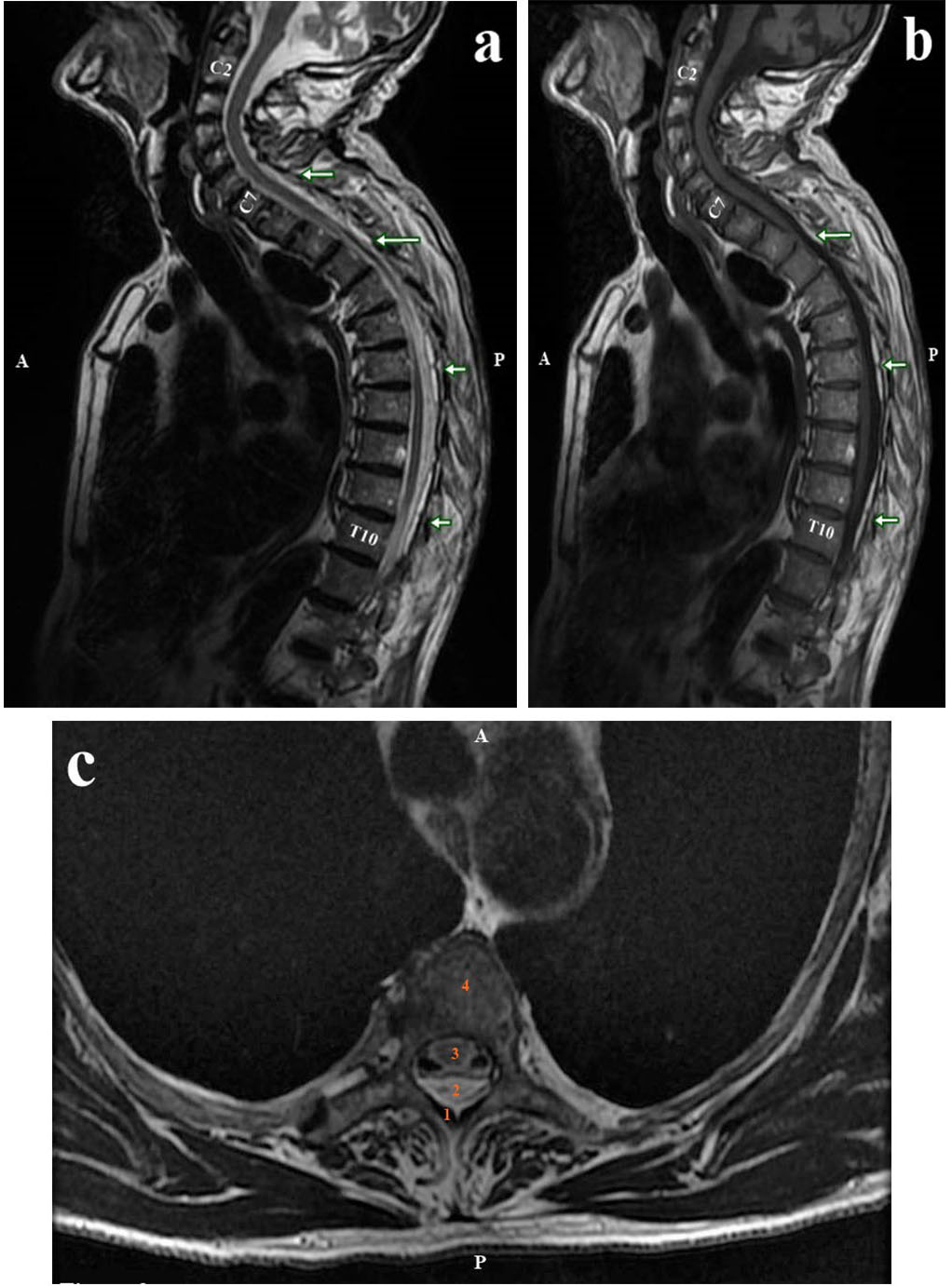 The MRI control examination performed 7 days after the first MRI
investigation. The sagittal plane T2W (a) and T1W (b) images show the presence
of a cervical and thoracic spinal cord hematoma extended from C7 to T10 vertebrae
(white-green arrows). The axial plane T2W (c) image shows the epidural hematoma
compressing the spinal cord. (c) 1, Ligamentum flavum; 2, Epidural hematoma; 3,
Spinal cord; 4, Vertebral body. A, anterior; P, posterior.