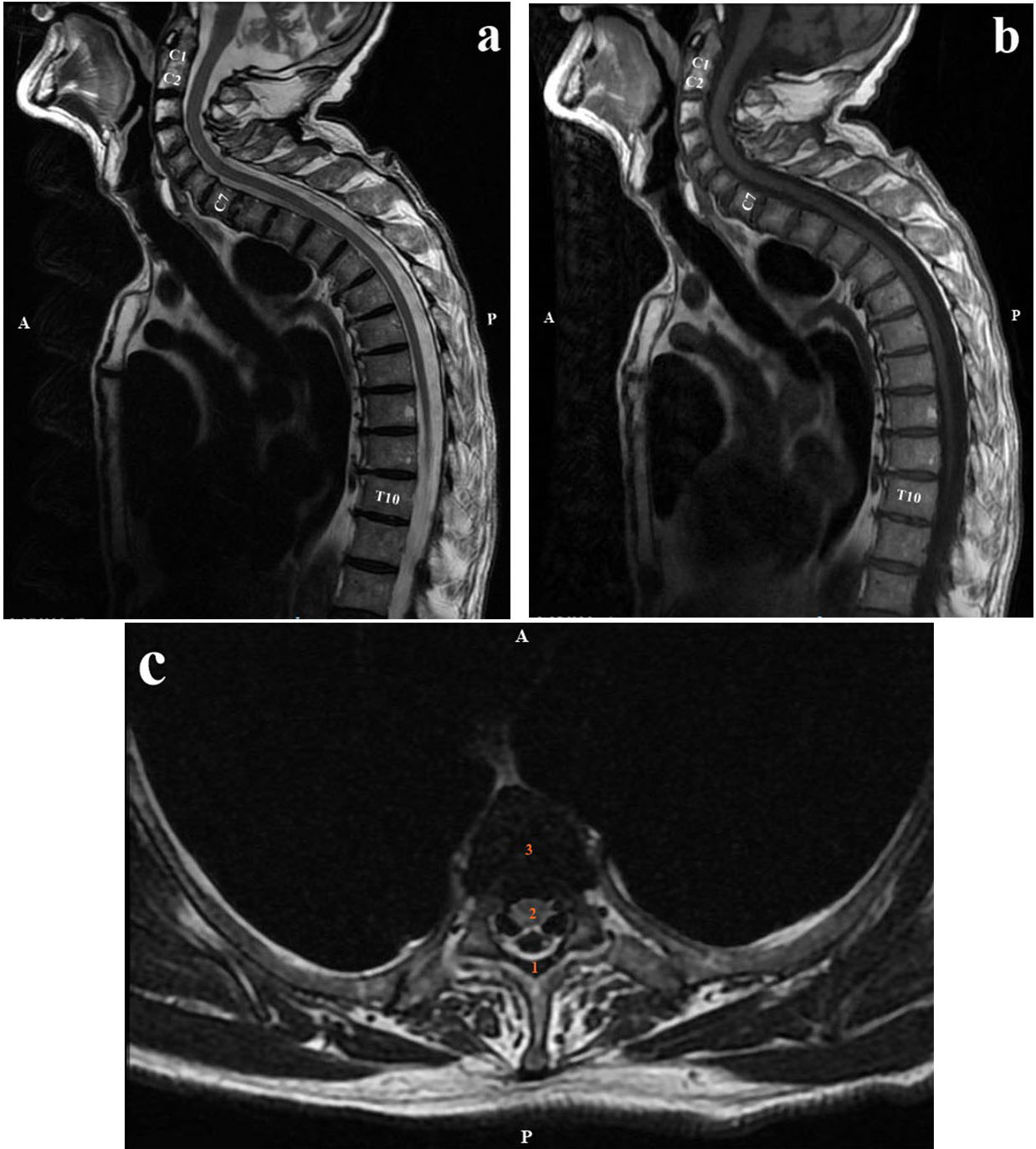The MRI examination performed at discharge. The sagittal plane T2W (a), T1W (b) and the axial plane T2W (c) images,
all show a complete regression of the spinal epidural hematoma. (c) 1, Ligamentum
flavum; 2, Spinal cord; 3, Vertebral body. A, anterior; P, posterior.