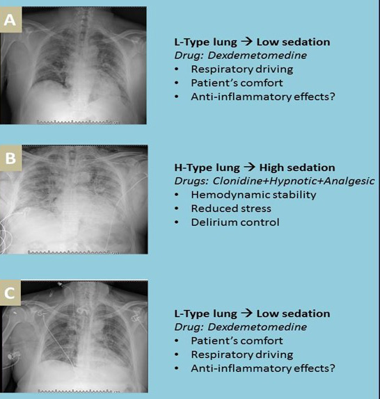 The three step sedation model. (A) The L-Type lung
phenotype may require light sedation through dexmedetomidine for maintaining the
respiratory drive and improve patient comfort. (B) A worsening in the respiratory
picture (Type H) may require mechanical ventilation. It imposes deep sedation
through hypnotic and analgesic medications. Compared to dexmedetomidine,
clonidine has fewer sedative properties (600 times lower); it can reduce the
hypnotic dose, providing better hemodynamic stability. (C) When respiratory
performance improves, dexmedetomidine-based light sedation can reduce the time to
extubation with beneficial effects on sedation-induced complications and
potential anti-inflammatory effects.