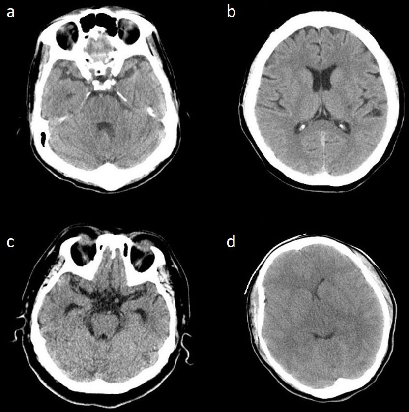 CT images of four patients who had an abnormal CT report. (a)
The brain CT report revealed a suspected cerebellar infarct. Refer to patient 1
in Table 3. (b) CT report revealed a suspected small infarct. Refer to patient 2
in Table 3. (c) CT report revealed a lacunar infarct and a possible left middle
cerebral artery aneurysm at M1 segment. Refer to patient 3 in Table 3. (d) CT
report revealed cerebral edema and increased intracranial pressure. Refer to
patient 4 in Table 3.